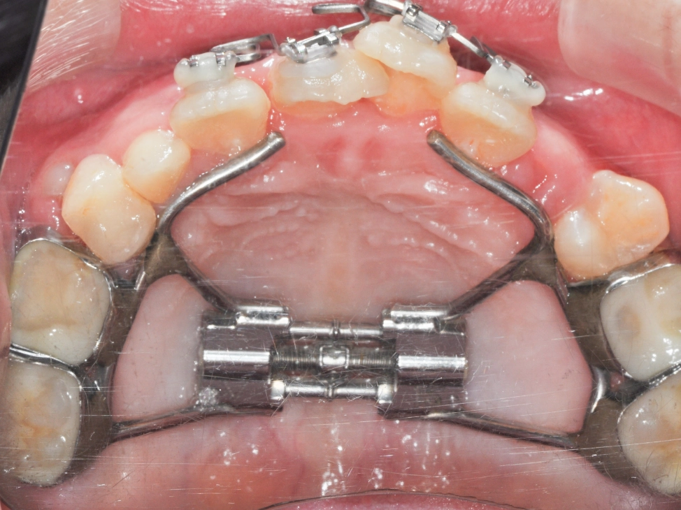 あごの骨格を広げる　※約半年