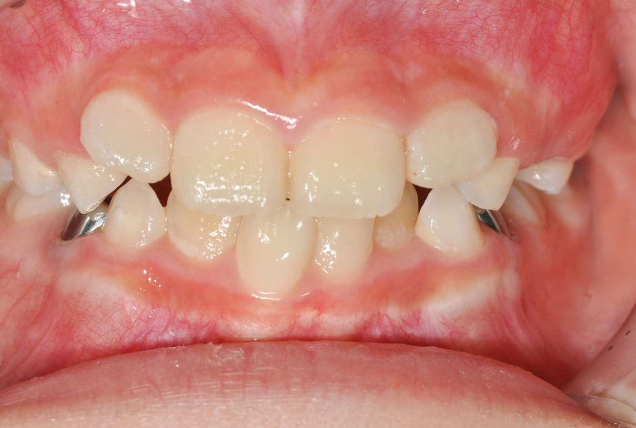 小児矯正 治療前