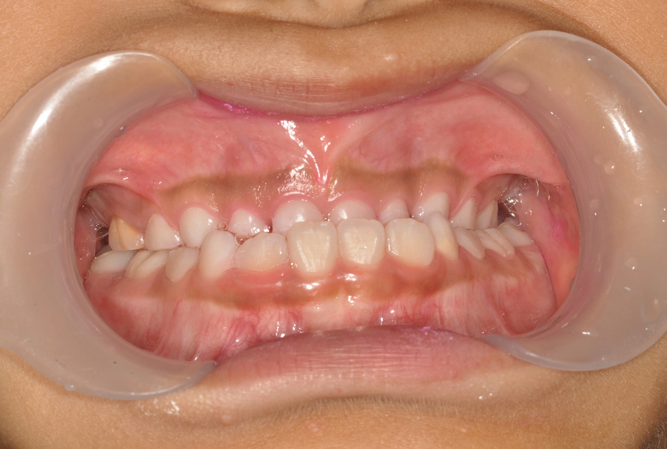 小児矯正 治療前