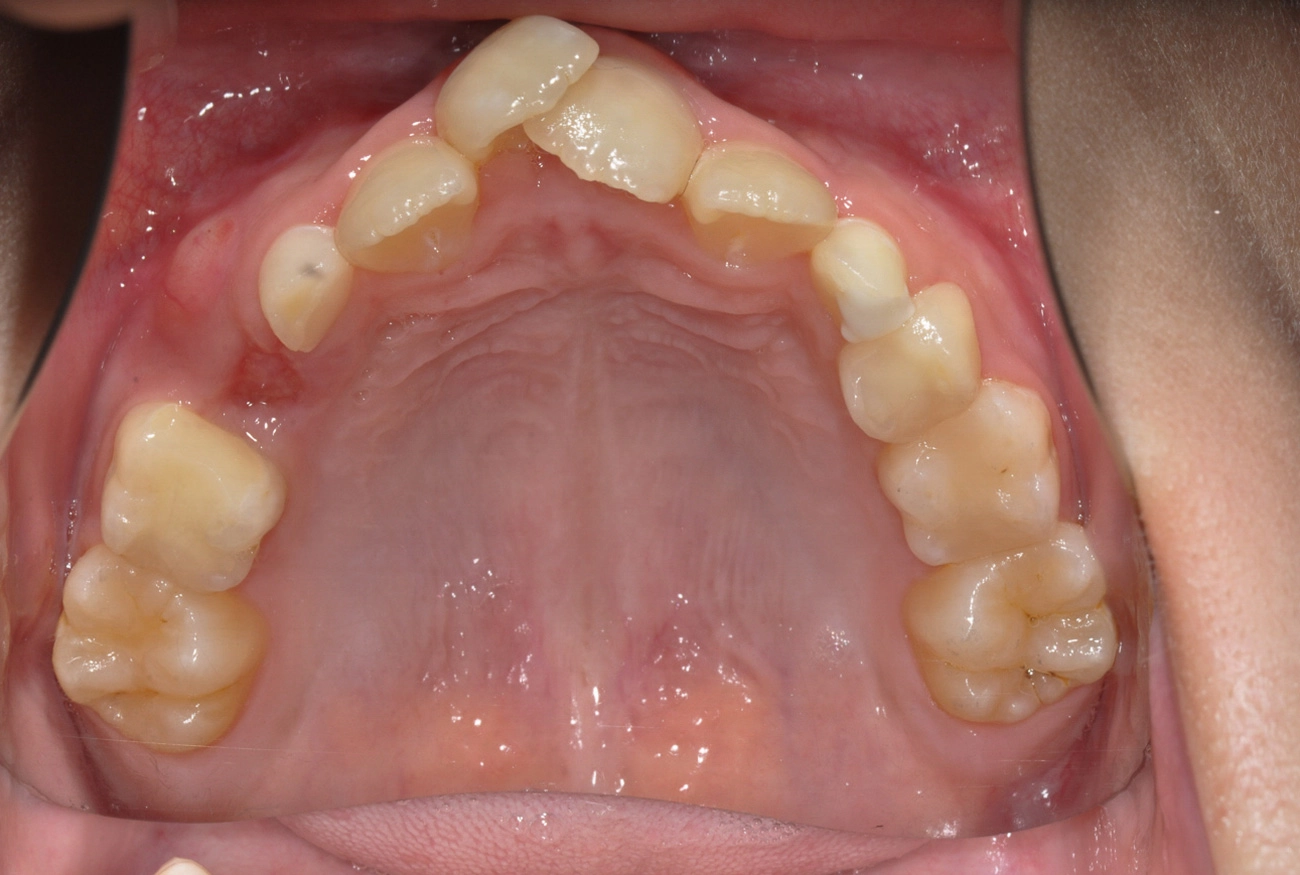 小児矯正 治療前