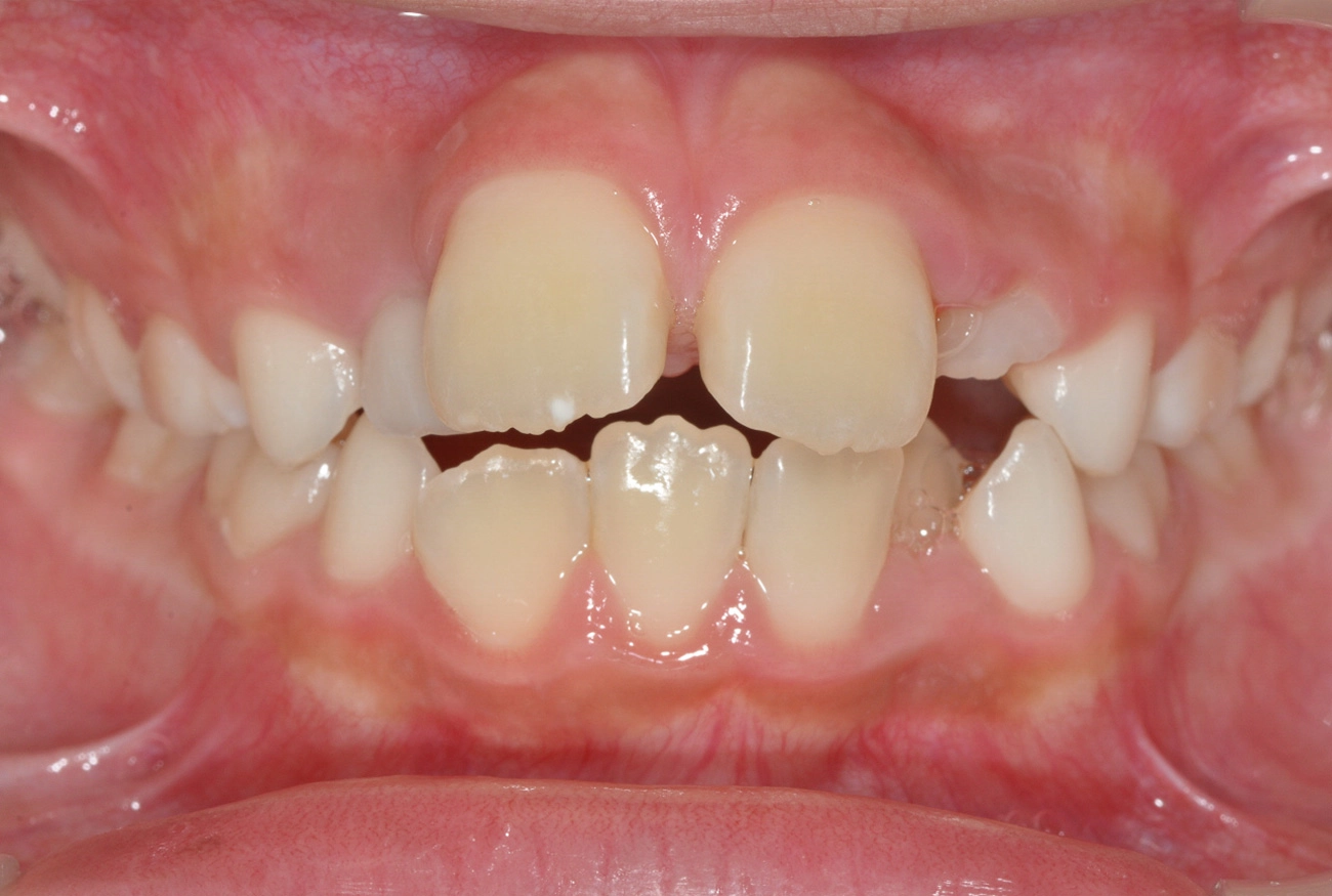 小児矯正 治療前