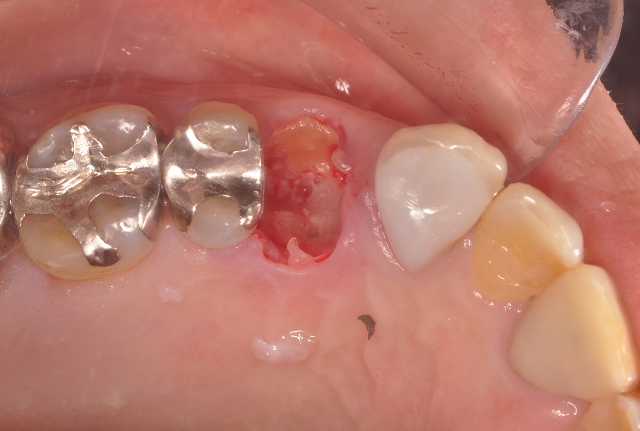 インプラント 治療前