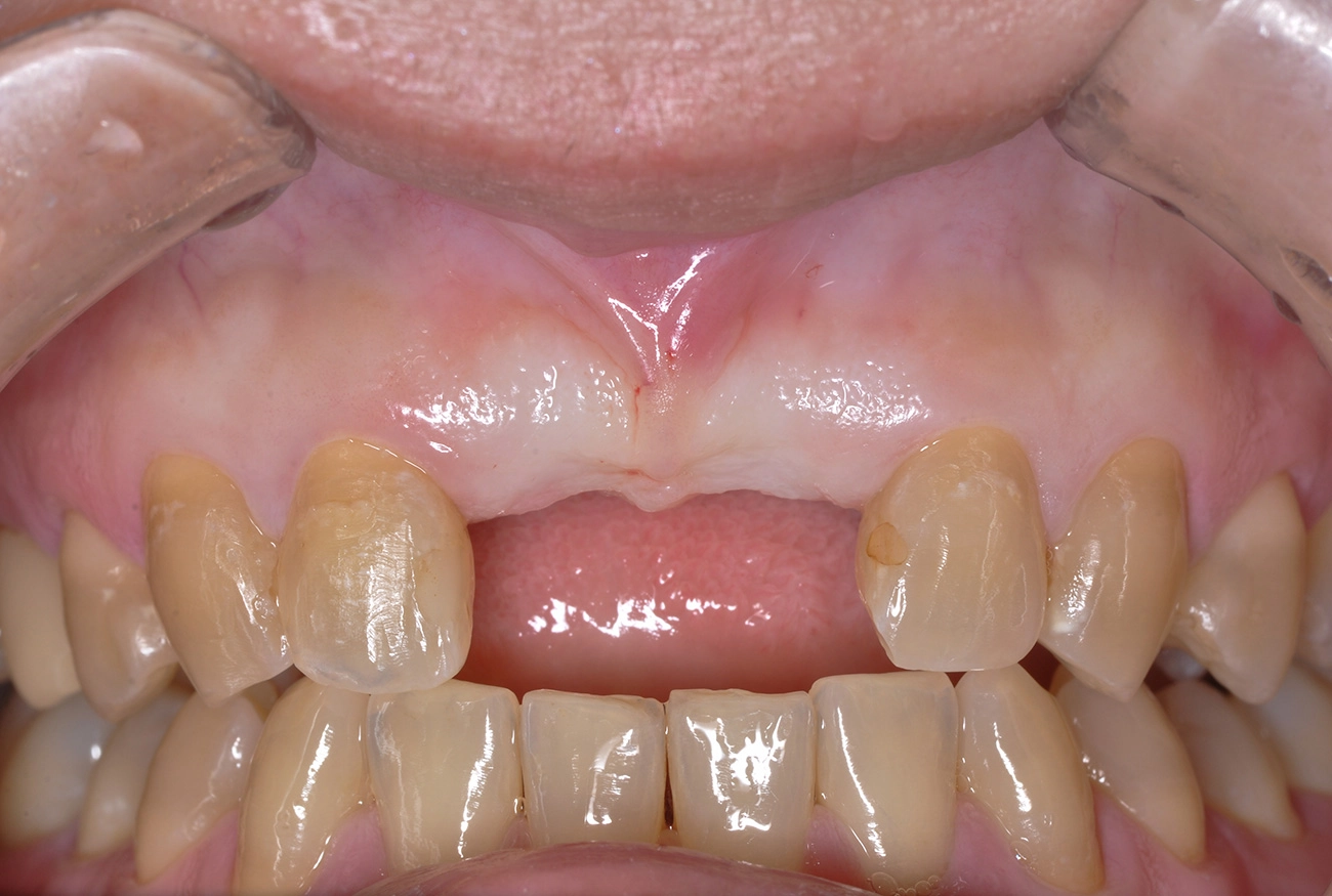 インプラント 治療前