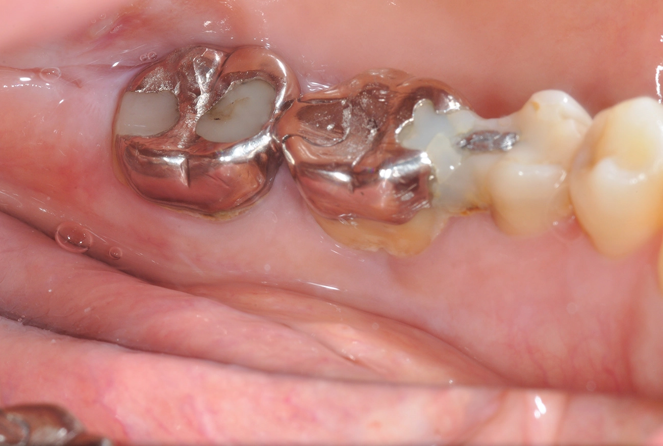 インプラント 治療前