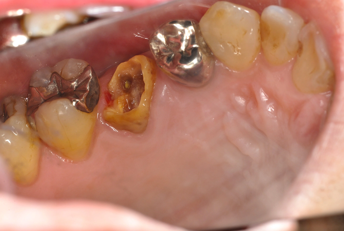 インプラント 治療前