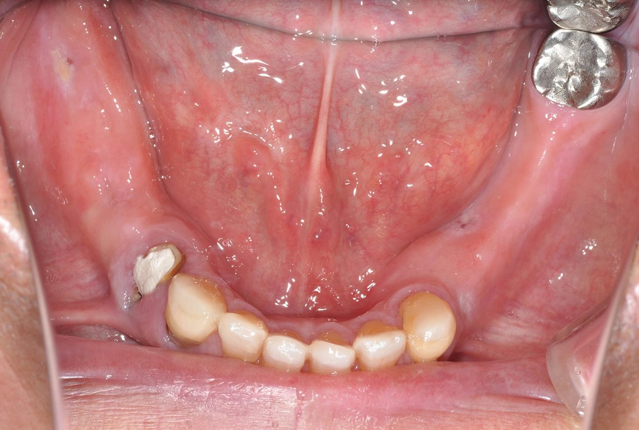 インプラント 治療前