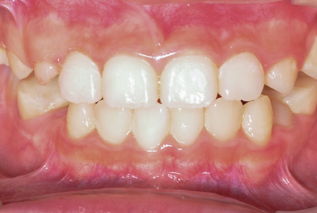 小児矯正 治療後