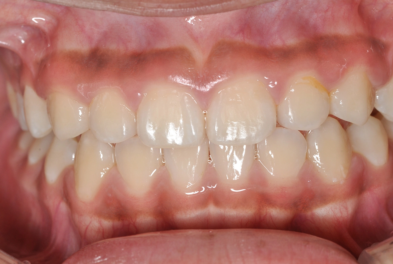 小児矯正 治療後