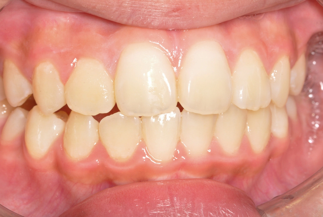 小児矯正 治療後