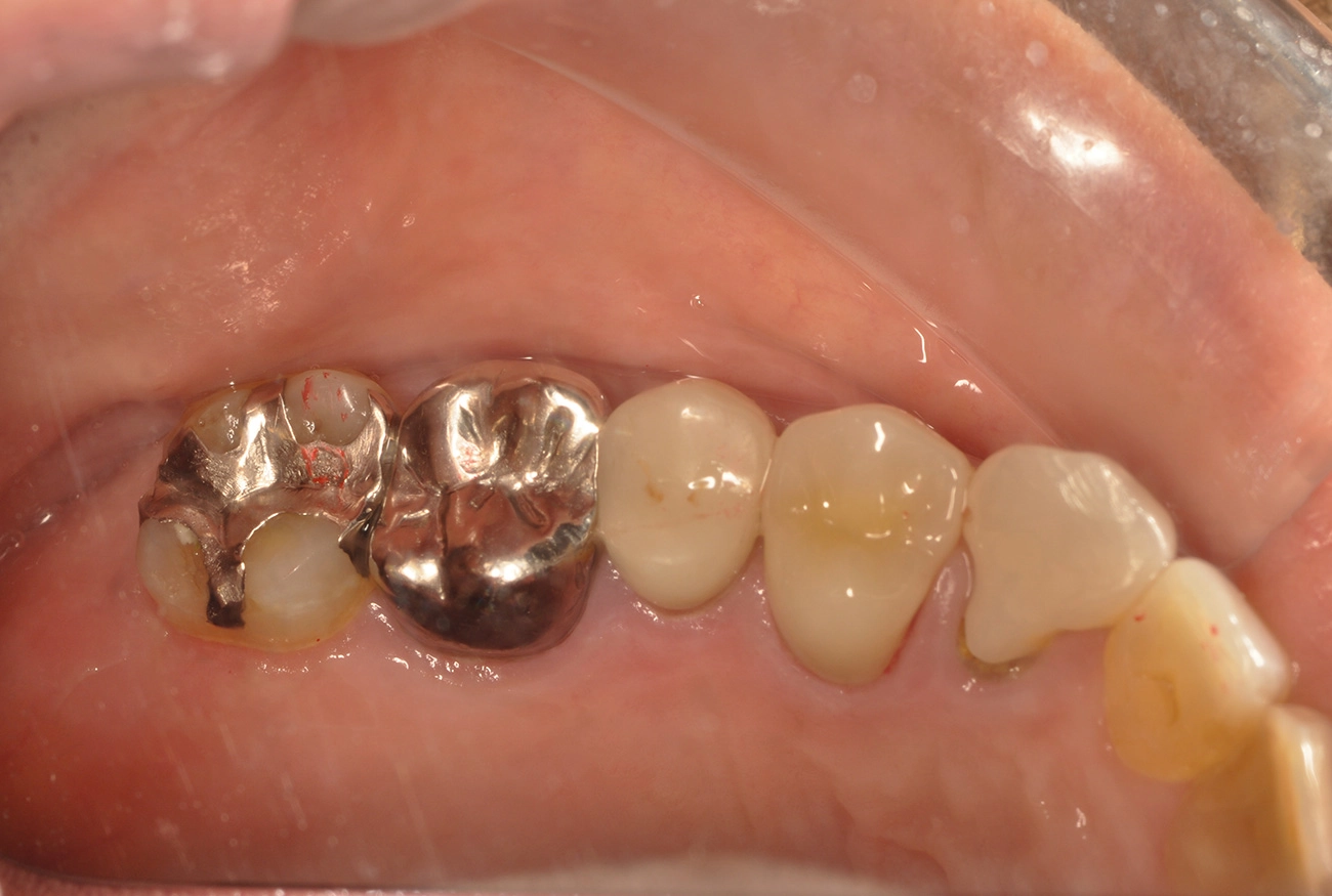 インプラント 治療後