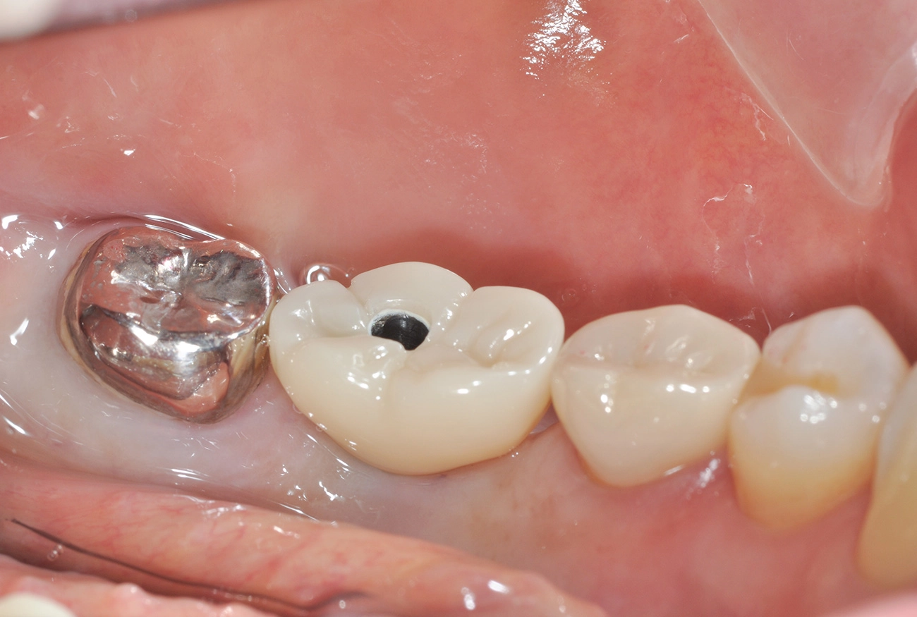 インプラント 治療後