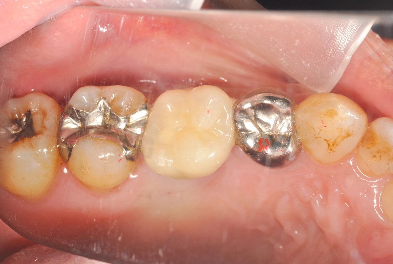 インプラント 治療後