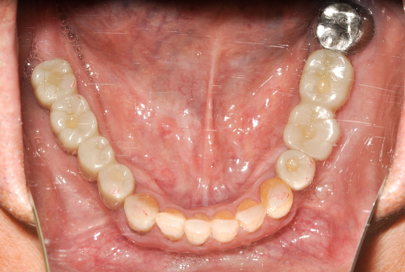 インプラント 治療後