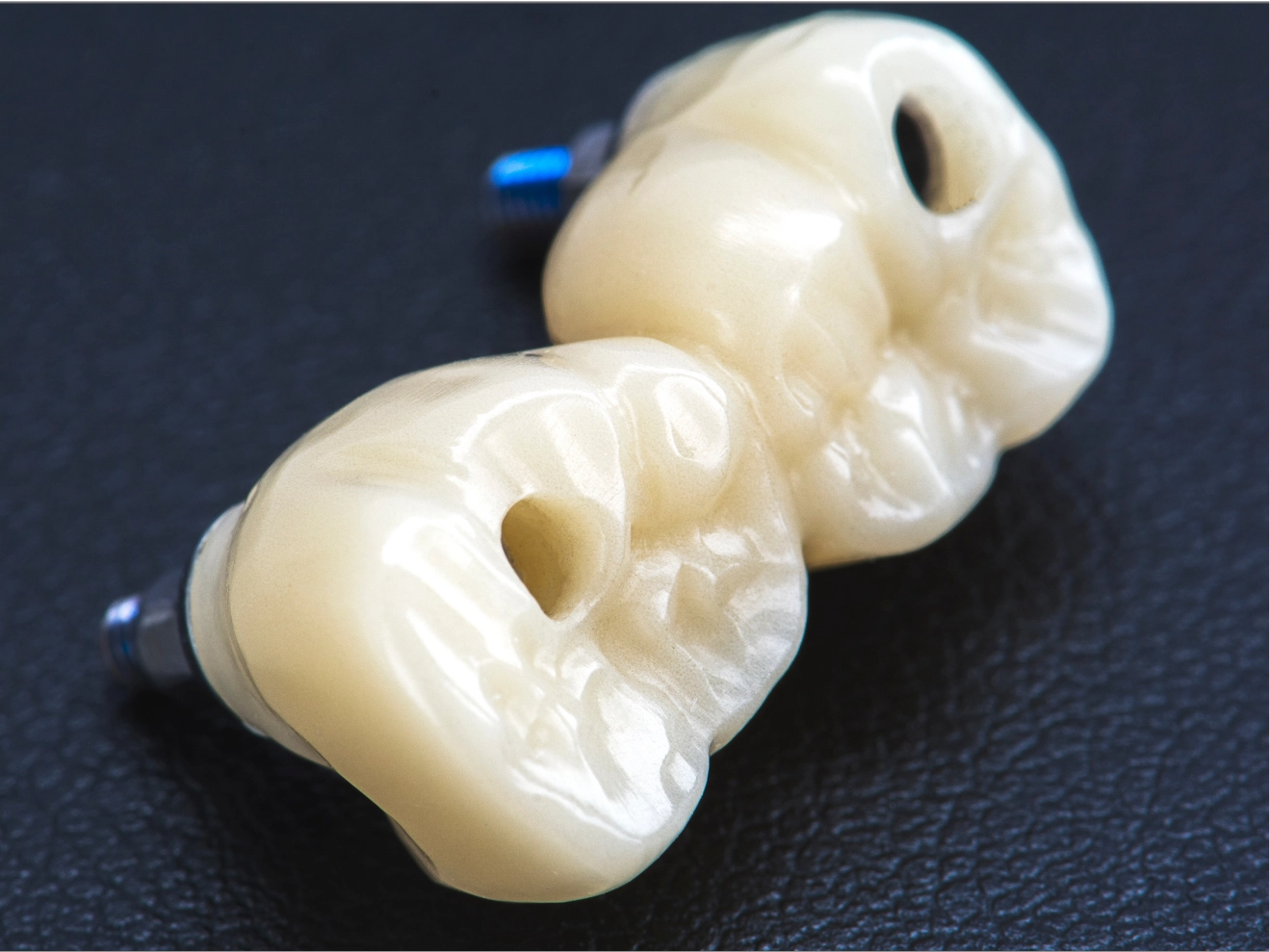 仮歯の装着・治癒期間