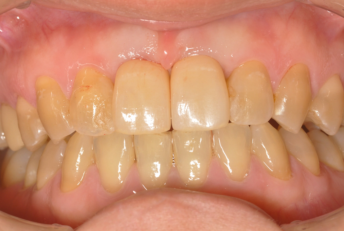 インプラント 治療後