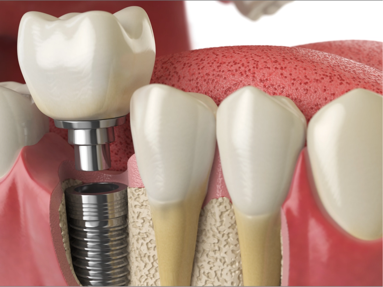 上部構造(かぶせもの)の装着