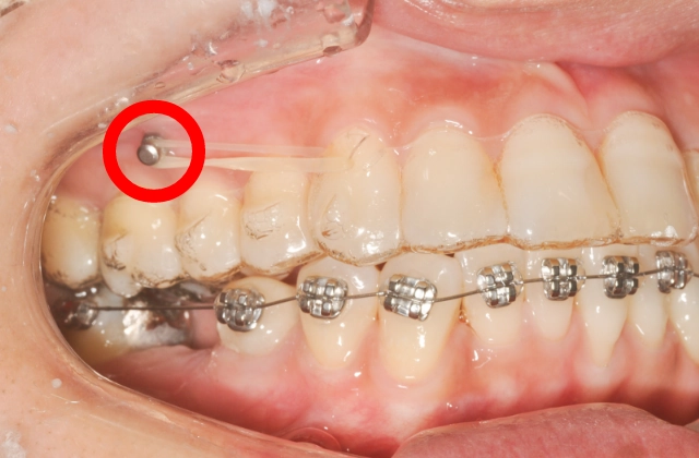 インプラントアンカー