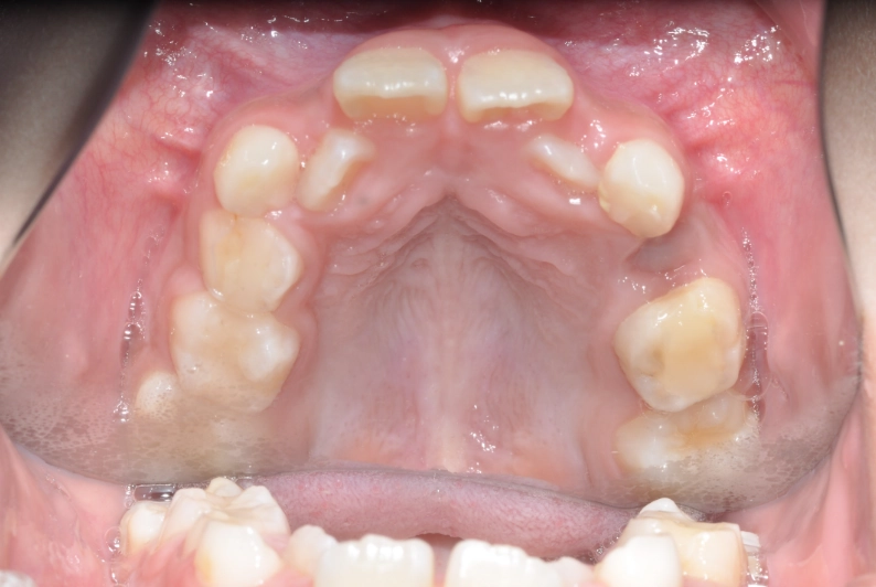 小児矯正 治療前