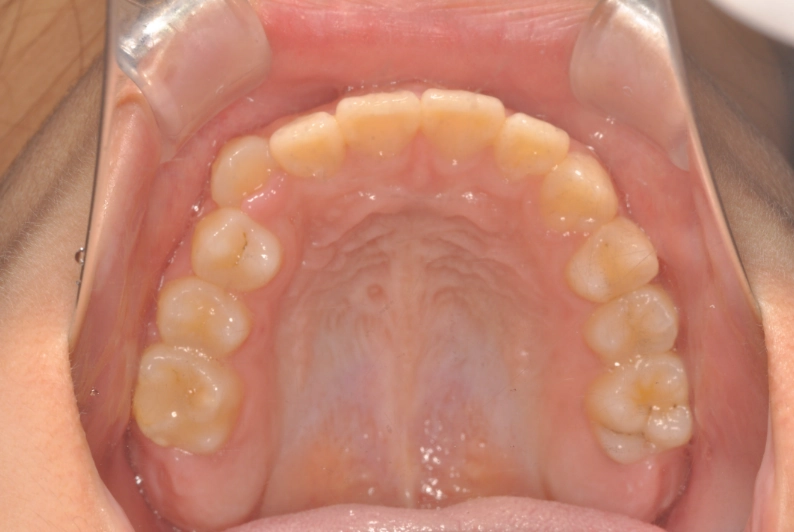 小児矯正 治療後