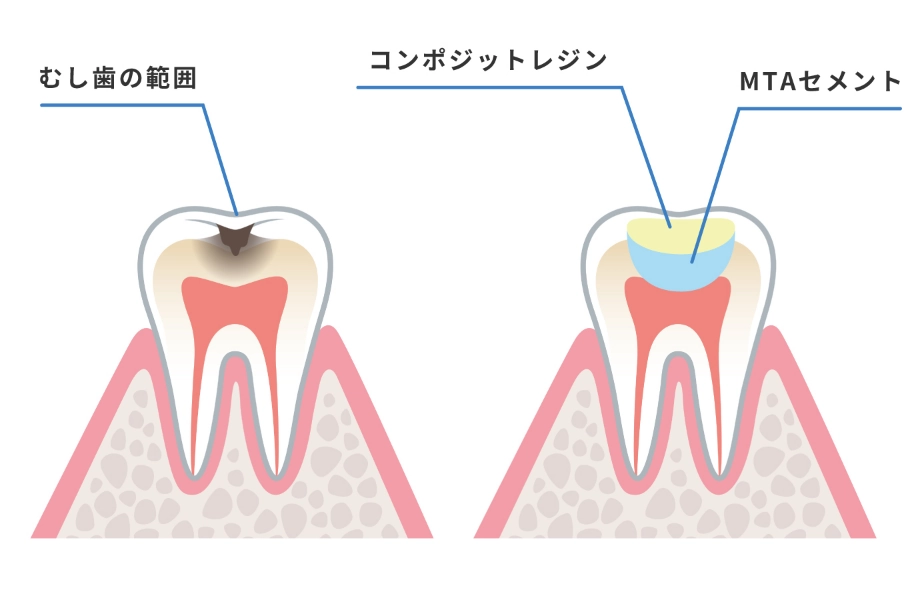 神経をなるべく残す治療（歯髄温存治療）